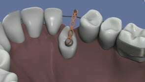 Orthodontie : la traction d'une canine palatine incluse