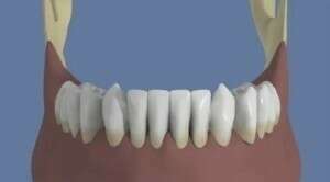 Mandibule : Bridge complet scellé sans fausse gencive