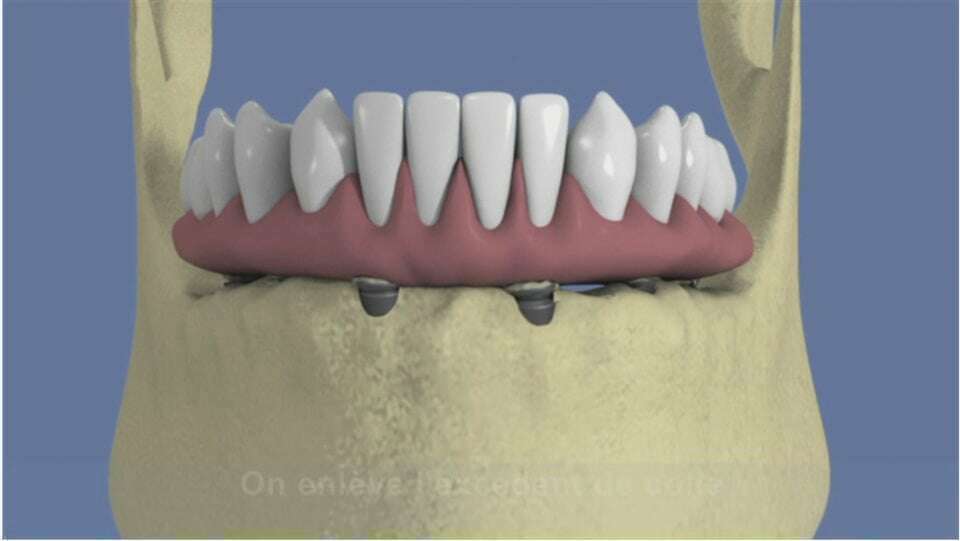 Mandibule complète et traitement implantaire pour un bridge fixe scellé
