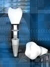 Implants