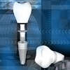 Implants