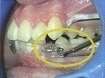 Orthodontie fonctionnelle: Insuffisance de croissance mandibulaire : Le P.U.L. (Propulseur Universel Light)