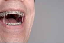 Les élastiques intermaxillaires