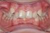 Dents qui se chevauchent, Cas avant