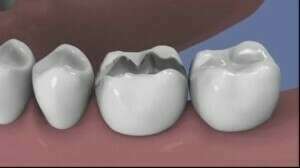 Extraction et comblement osseux