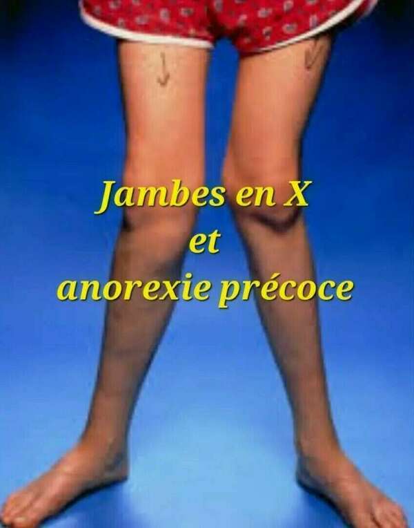 Jambes en X et anorexie