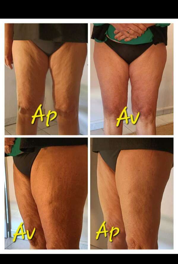 Drainage manuel combiné au massage minceur