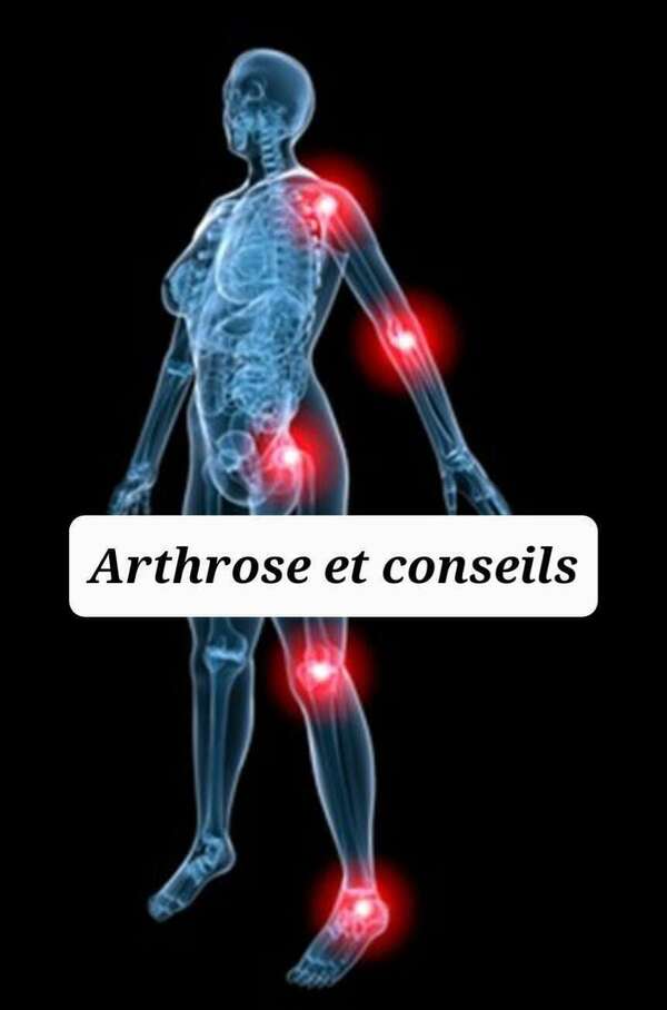 Arthrose et conseils