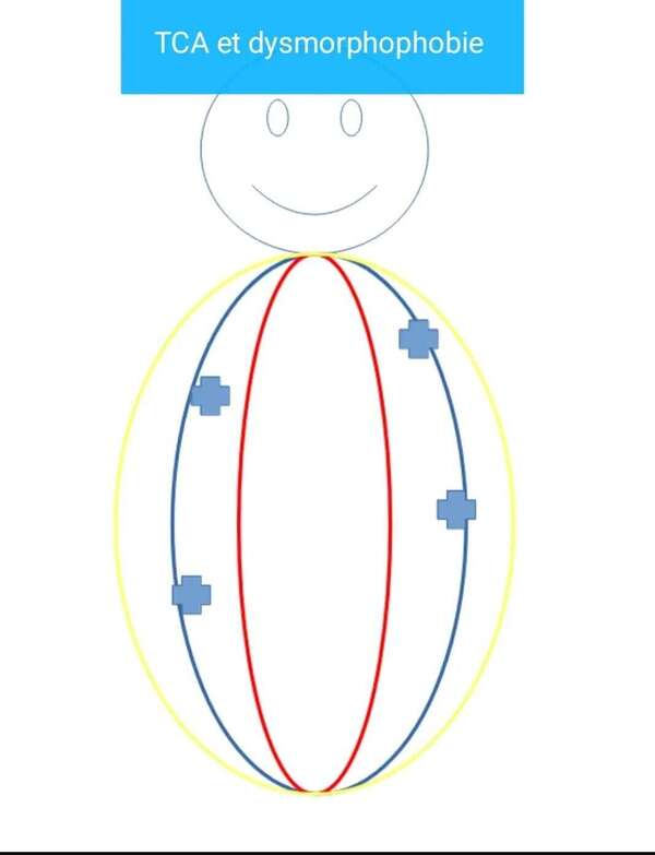 Dysmorphophobie