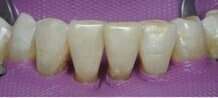 CAS CLINIQUE : DENTISTERIE ADHÉSIVE / DENTISTERIE ESTHÉTIQUE