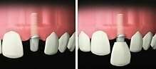 QU’EST-CE QU’UN IMPLANT DENTAIRE ?