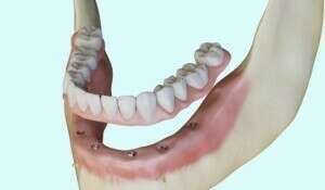 Prothèse complète vissée sur implant