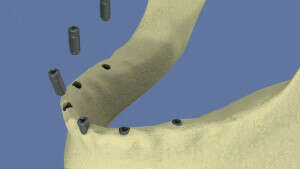 Mandibule complète et traitement implantaire pour un bridge fixe vissé