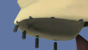 Maxillaire 8 implants et comblement de sinus