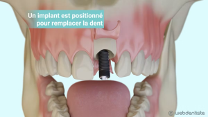 Extraction et implantation immédiate – Mise en esthétique directe