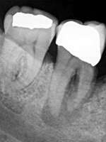Le kyste apical, l'apectomie