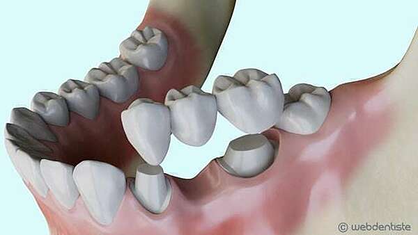 Remplacement d’une dent absente par un bridge