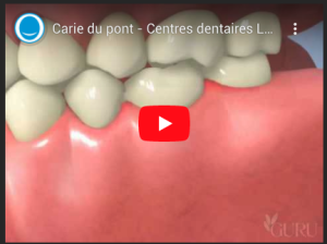 Carie du pont