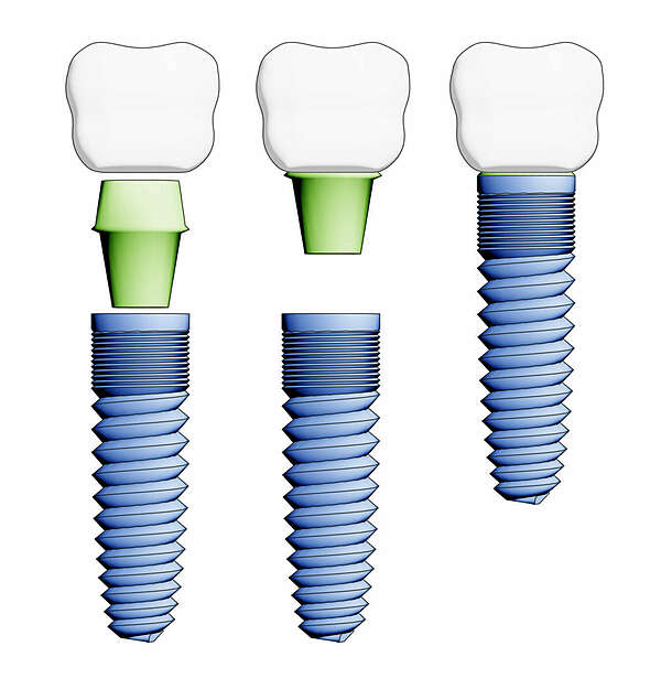Implantologie Mandelieu La Napoule