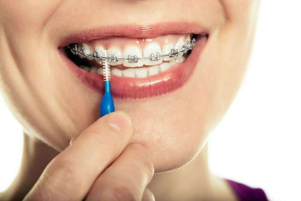 Technique orthodontique - Marseille
