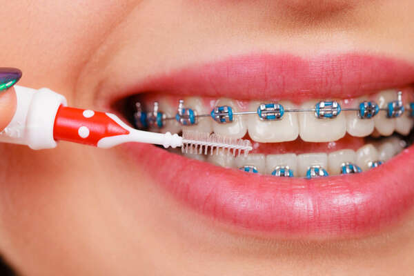 Orthodontie de l’adulte par bagues/brackets linguaux