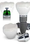 implant
