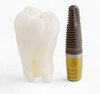 Implants dentaires