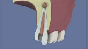 Retraitement canalaire