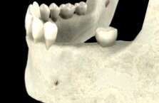 LA GREFFE OSSEUSE D'APPOSITION OU GREFFE EN ONLAY - TOULOUSE (31200)