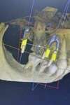 Implant dentaire, implantologie assistée par ordinateur