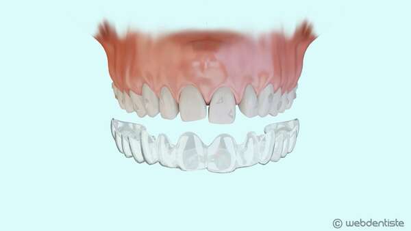 Traitement orthodontique esthétique par gouttières