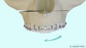 La chirurgie orthognatique – correction de l’asymétrie faciale