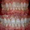 Photo clinique des dents de face, esthétique dentaire
