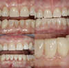 Photo clinique des dents de face, arcades écartées