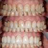 Photo clinique des dents antérieures du haut et du bas