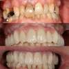 Photo clinique d'un sourire, dents antérieures