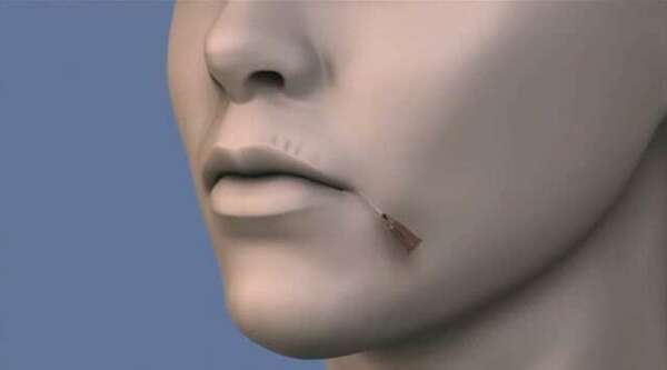 Corriger le vieillissement péri-buccal grâce à l’acide hyaluronique