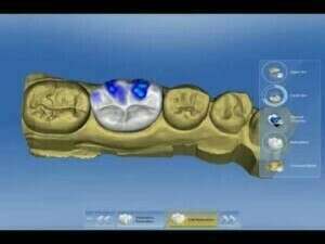 Sirona CEREC SW 4.0. Complete Demonstration.