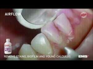 Séance de prophylaxie et prévention dentaire