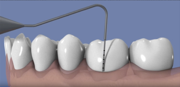 Le traitement non chirurgical de la parodontite