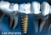 Les implants dentaires