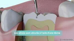 Prévention : scellement de sillons chez l'enfant