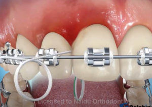 Nettoyage des brackets avec du fil dentaire