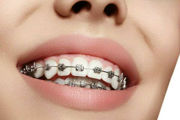 Intérêts d'un traitement orthodontique