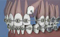 Dégagement orthodontique d’une canine incluse