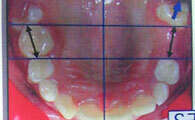 Extraction de dent temporaire et suivi orthodontique