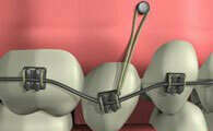 Les mini-vis en orthodontie