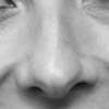 Rhinoplastie médicale