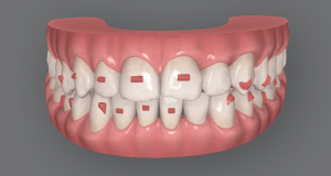 Les avantages des aligneurs