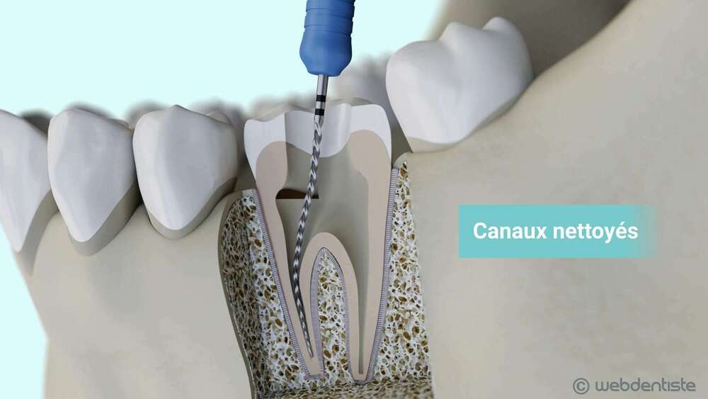 La dévitalisation